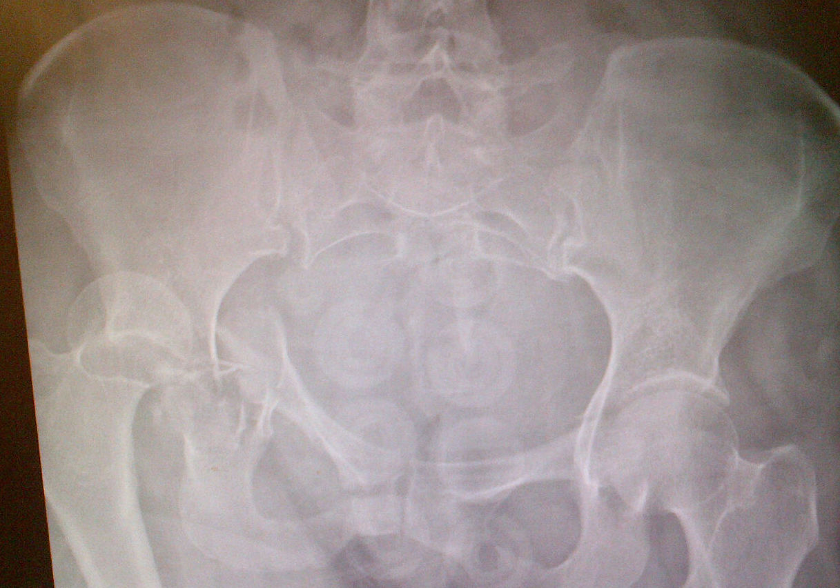 Hip fracture dislocation